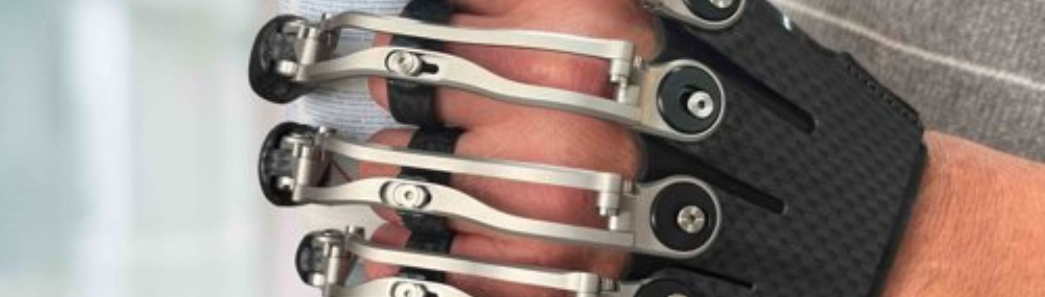 Finger prosthesis in Belgium - Amputee Care Center