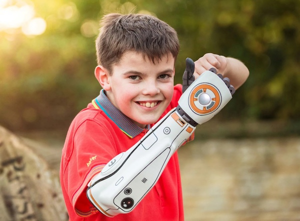 Custom prostheses: because no two people are the same